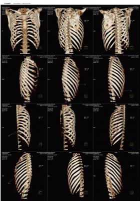 醫用ct膠片-肋骨